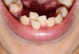 Treatment Options for Crowded Teeth You Should Consider
