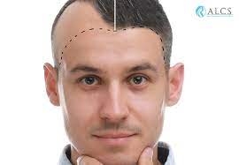 FUE vs. FUT: Choosing the Best Hair Transplant Method in Islamabad