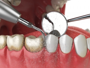 How Teeth Cleanings Help Prevent Gum Disease
