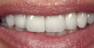 Zahnaufhellung: Der ultimative Leitfaden für ein strahlenderes Lächeln