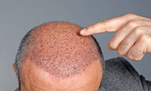 Luxury vs. Affordable Hair Transplants in Islamabad – What’s the Difference?