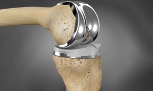 Artificial Implants Market 2031: Key Drivers, Growth Analysis, and Challenges