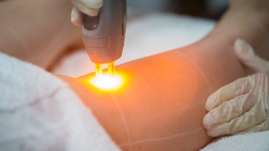 Challenges and Opportunities in the Laser Hair Removal Market