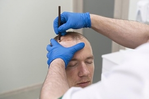 Decoding the Cost: How Much Does a Hair Transplant Really Cost in Islamabad?