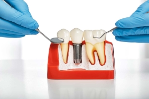 Dental Implants, A Lifelong Investment for Your Smile