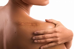Regional Analysis of the Hypertrophic Scar Market