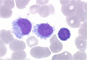Diagnostic Advancements in the Antibody-Mediated Rejection Market