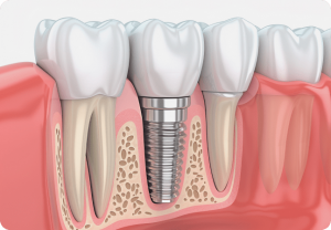 Mooresville Dental Clinic: Affordable, Quality Care for All Ages