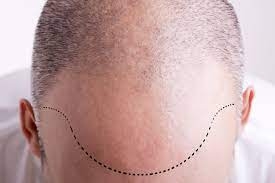 Finding the Right Hands: Your Guide to Choosing a Hair Transplant Specialist in Islamabad