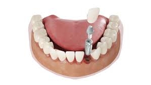 What to Expect When Your Dentist Says You Need a Tooth Implant - Ramoth, VA