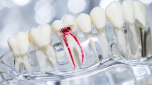 7 Signs You Might Need a Root Canal Treatment 