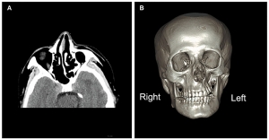 The Rising Prevalence of Parry Romberg Syndrome Market will Drive Market Growth owing to Improved Diagnosis