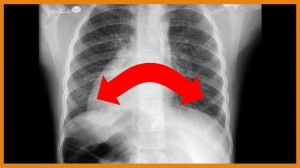 Primary Ciliary Dyskinesia Diagnostics Market Will Grow at Highest Pace Owing to Technological Advancements 