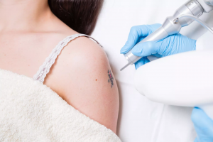 Why Laser Tattoo Removal in Dubai is the Most Advanced in the World