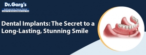 Dental Implants: The Secret to a Long-Lasting, Stunning Smile
