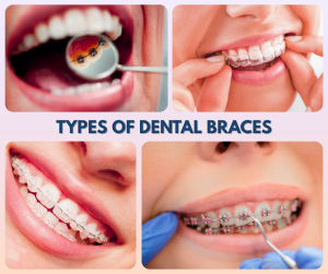 Types of Dental Braces 