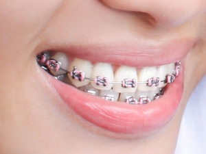 Braces for a Better Smile: Pros and Cons