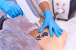 Outgrown Your Ink? Let’s Remove It Painlessly with Laser Tattoo Removal!