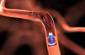 Recanalization Devices Market: Industry Growth and Forecast Analysis