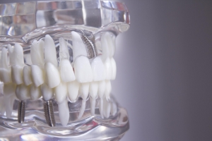multiple dental implants