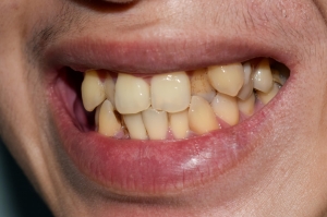 Treatment Options for Fixing Overlapping Teeth
