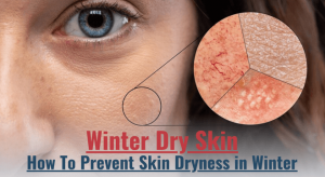 Ultimate Guide to Banishing Dry Skin This Winter!