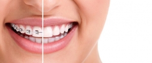 Powerful Tips for a Clean & Healthy Smile with Braces