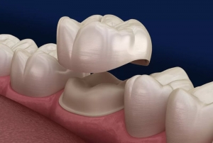 How Long Do Dental Bridges Last? Tips for Maintenance