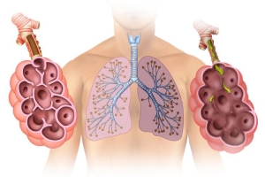 Emphysema Treatment is Estimated to Witness High Growth Owing to Advancements 