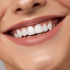 Teeth Whitening, The Key to a Confidence Boost