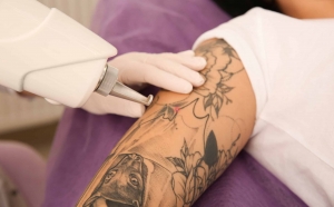 Low Pain, High Gain – The Most Comfortable Laser Tattoo Removal!
