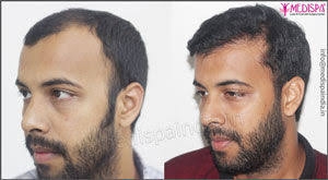 Best Hair Transplant Clinic in Dubai – A Complete Guide