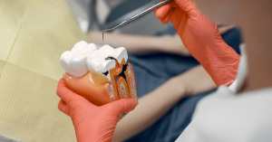 Root Canal Treatment for Teeth