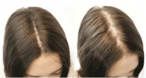 Best Thinning Hair Treatment for Women to Restore Volume