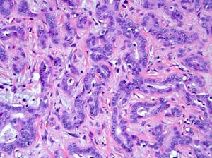 Treatment Options will grow at highest pace owing to Intrahepatic Cholangiocarcinoma Market