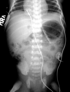 The Rise of Neonatal Care will drive the Necrotising Enterocolitis Market growth