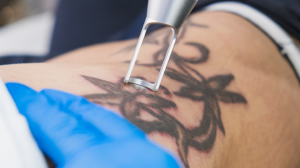 Full Tattoo Removal or Fading for a Cover-Up? Laser Tattoo Removal Lets You Choose!