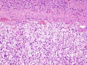 The Pheochromocytoma Treatment Market is driving by rising incidence of pheochromocytoma