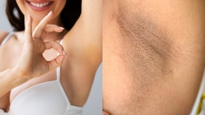 Dark Underarms Treatment: What Dermatologists Suggest for Lasting Results