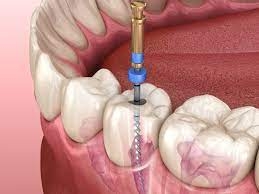 What Are The Signs That You May Need A Root Canal?