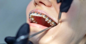 What Are Teeth Braces?