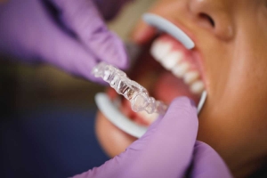 Is Invisalign Worth It? Deciding on Your Smile