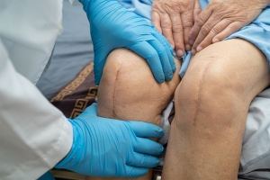 Knee Replacement Surgery 