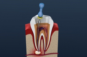 Why You Should See a Root Canal Specialist for Treatment