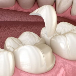The Best Ways to Treat a Chipped Tooth and Restore Your Smile