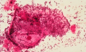 Challenges Facing the Bacterial Vaginosis Market