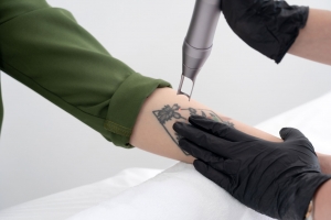 Ink Be Gone! Speedy Laser Tattoo Removal
