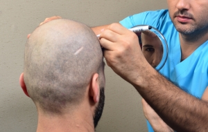 Regrow Your Hair with Dubai’s Advanced Hair Loss Treatment
