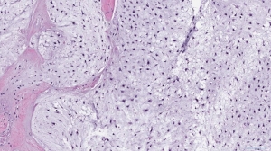 Chondrosarcoma Market Witnesses Significant Growth Due to Rising Prevalence of Bone Cancer Globally