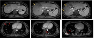 Case Sharing | Cryosurgical System for Lung metastasis of liver cancer